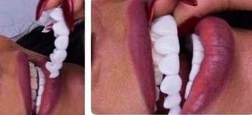 لمینت دندان  موقت چیکار میکنه